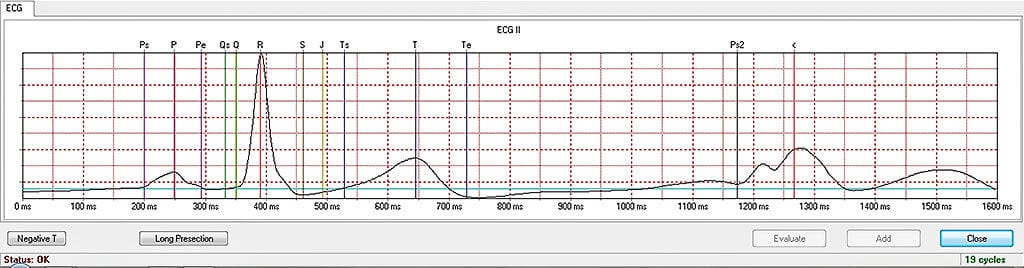 MDE GmbH - Zebrafish Systems - Averaged ECG Analysis From Cycles Selected By The User